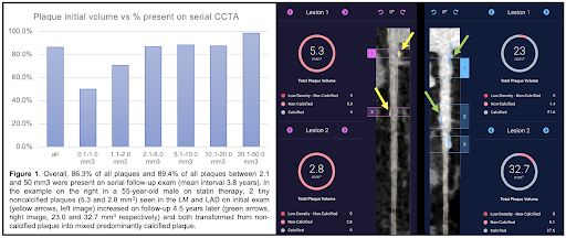 Early Atherosclerosis on CCTA: Insights from Artificial Intelligence-Enabled Quantitative CT Analysis of Serial Scans from the PARADIGM Trial
