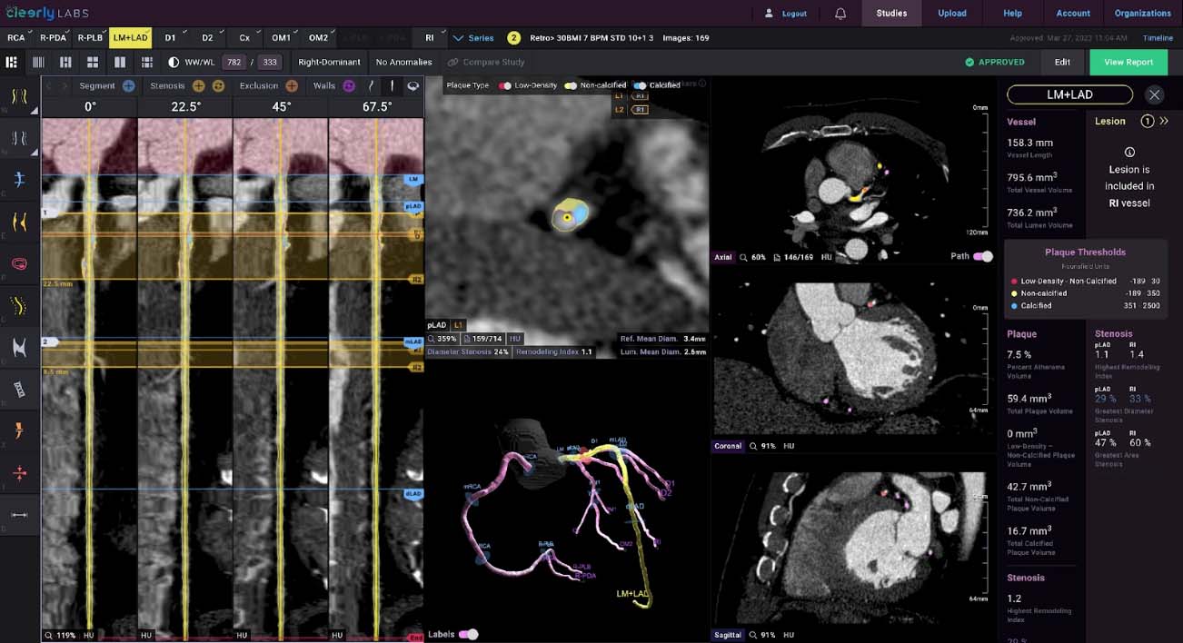 cleerly-analysis-screen-heart-technology