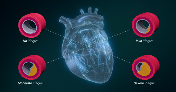 coronary-artery-disease-plaque-volumes