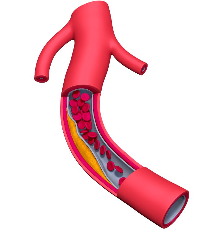 danger-coronary-artery-disease-cutout