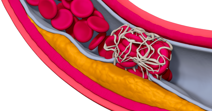 danger-coronary-artery-disease-rupture