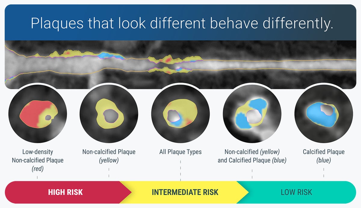 cleerly-plaque-behavior-graphic-v2