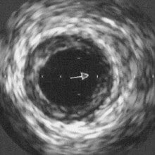 other-methods-ivus