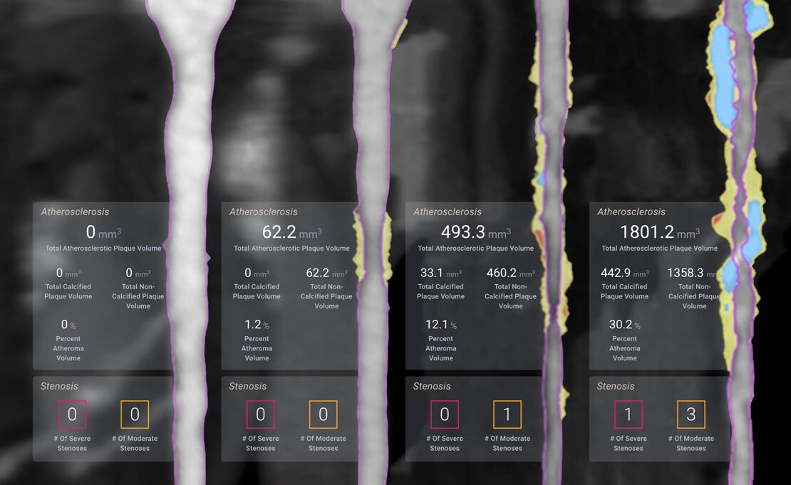 CCTA Based Atherosclerosis Treatment Algorithms