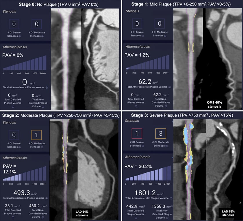 Examples of patients with Stage 0, Stage 1, Stage 2, Stage 3 atherosclerosis