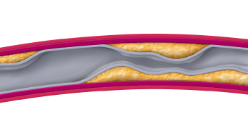 cleerly-reveals-ischemia-illustration