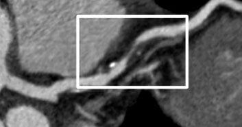 cleerly-reveals-stenosis-ccta