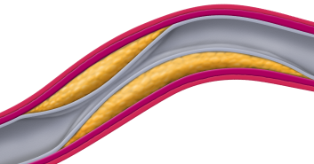 cleerly-reveals-stenosis-illustration